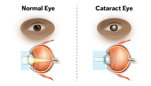 cataract vs normal eye poster in eye clinic in Abuja