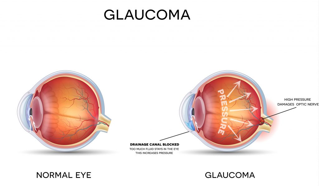 glaucoma poster at eye doctor's office