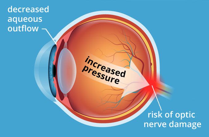 eye clinic abuja eye pressure